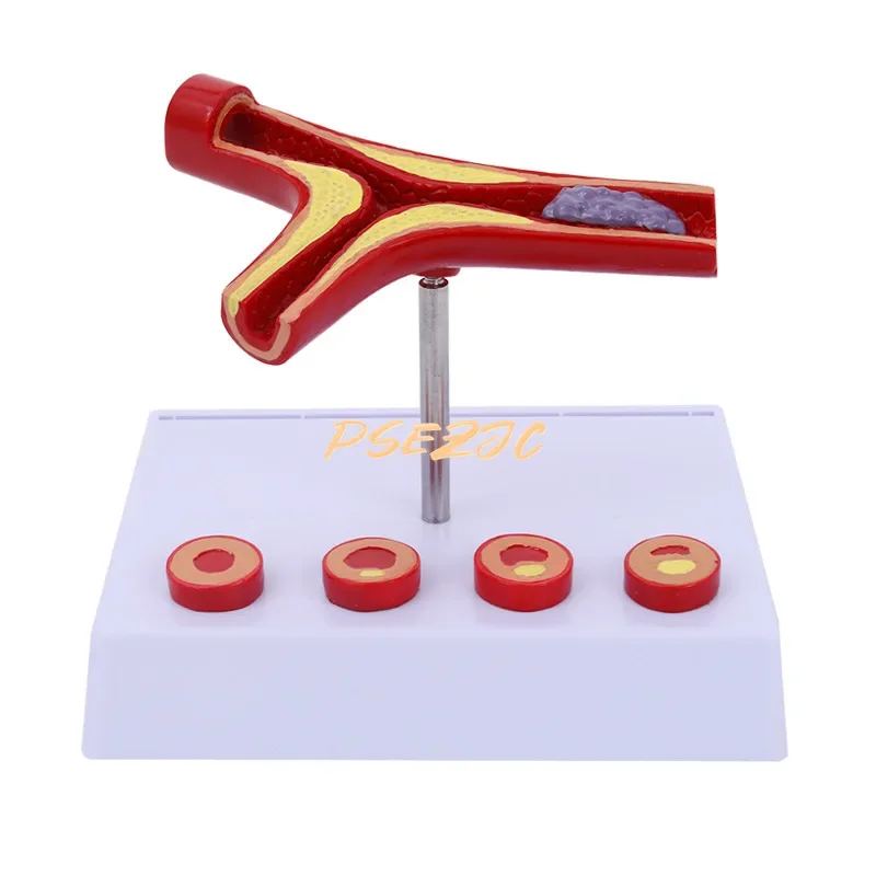 PVC Coronary Cardiovascular Model Sclerosis Elderly Heart  Vascular  Medical Teaching Supplies