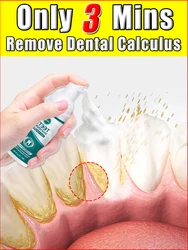 Remover manchas de cálculo dentário reduz o amarelecimento dos dentes, o cuidado das gengivas, a respiração fresca, iluminando os dentes