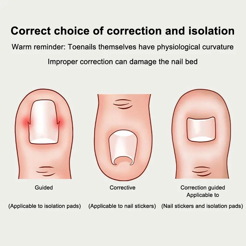 คุด Toenail Correction เครื่องมือคุดเล็บยืดหยุ่น Patch สติกเกอร์ยืดคลิปรั้ง Pedicure เครื่องมือ