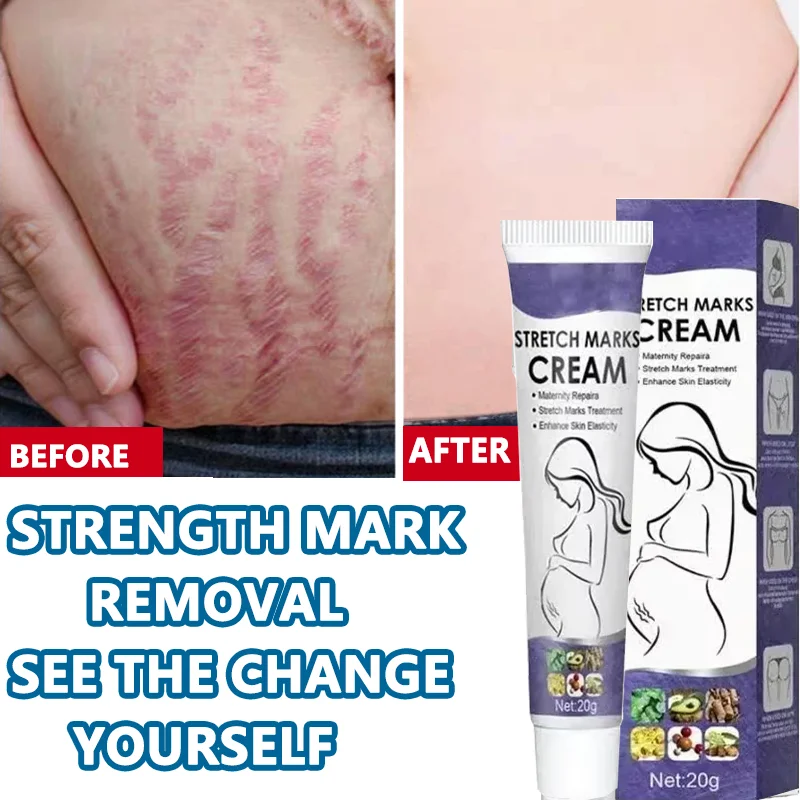 

Stretch Mark Vanishing Cream Remove Body Buttock Breast Marks Effective New Old Stretch Mark Removal Smooths body skin texture