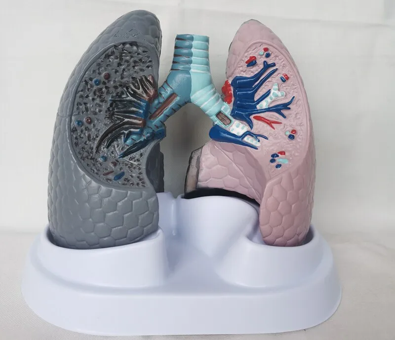 Smoking Cancerous Lung Model vs Healthy Lung Model Human Organ Anatomical Model Tobacco Hazards Teaching Demonstration Model