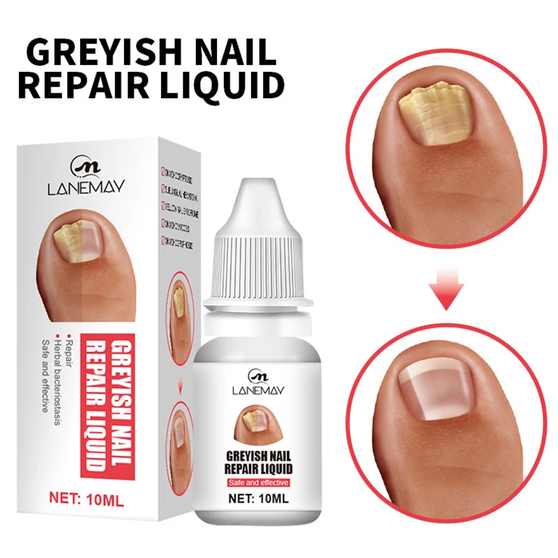 

Efficient Nail Repair Solution Treating Cracked Discolored Nails Gray Foot Care Toe Nail Sterilization Gel Nourishing Essence