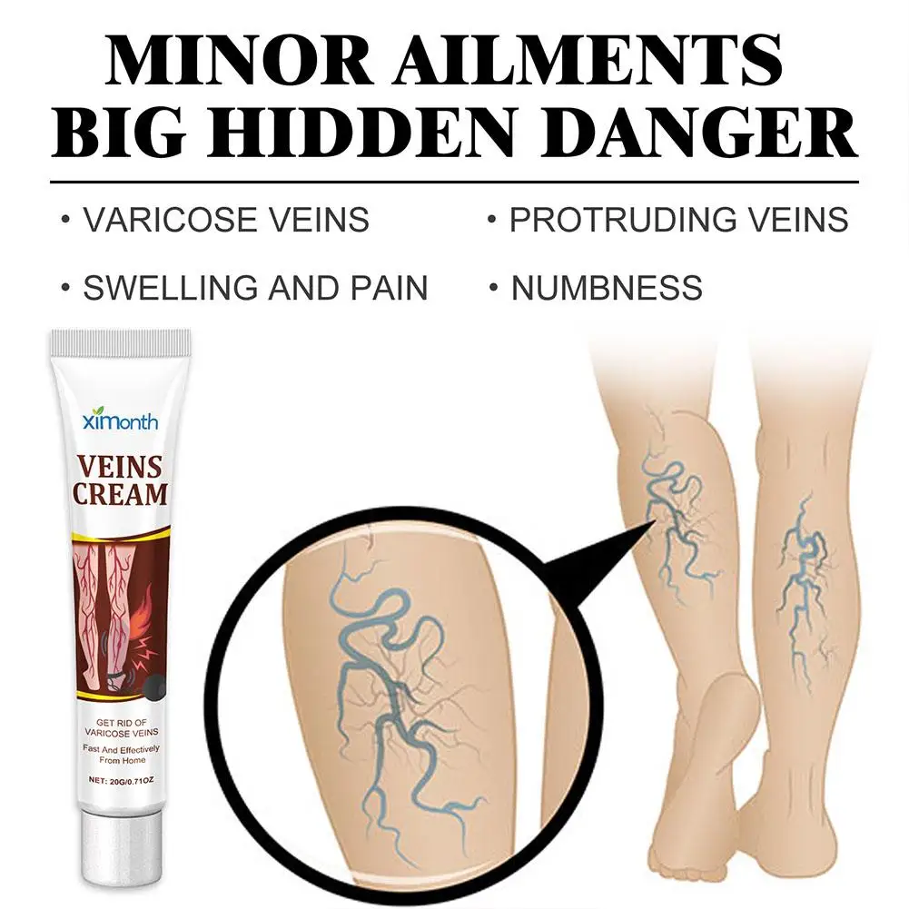 Vein Treatments Cream Effective Relieve Legs Dilated Vasculitis Phlebitis Natural Formula Ointment For Varicose Veins