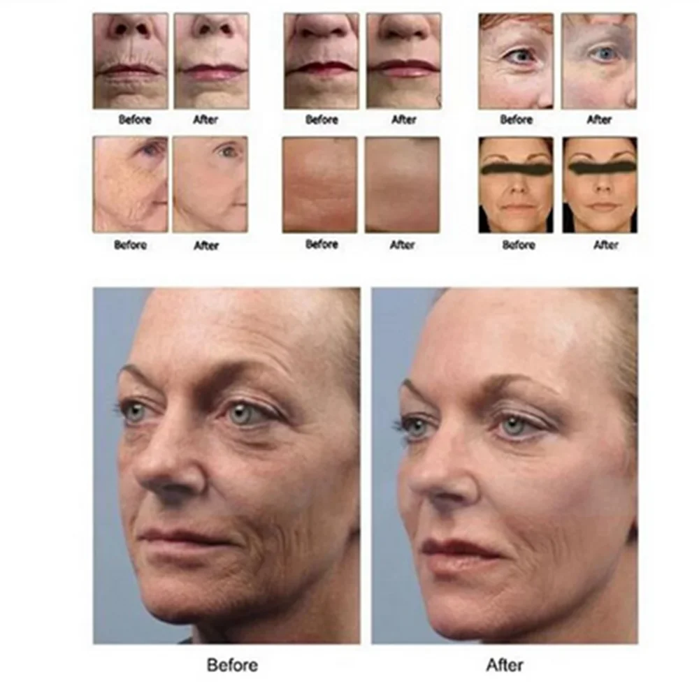 Direkt ab Werk: 20.000 Schüsse, 12 Linien, 3D/4D HIFU-Transducer, austauschbare Gesichts- und Körperkartusche für Anti-Aging-Gesichtsgeräte – Detail 6