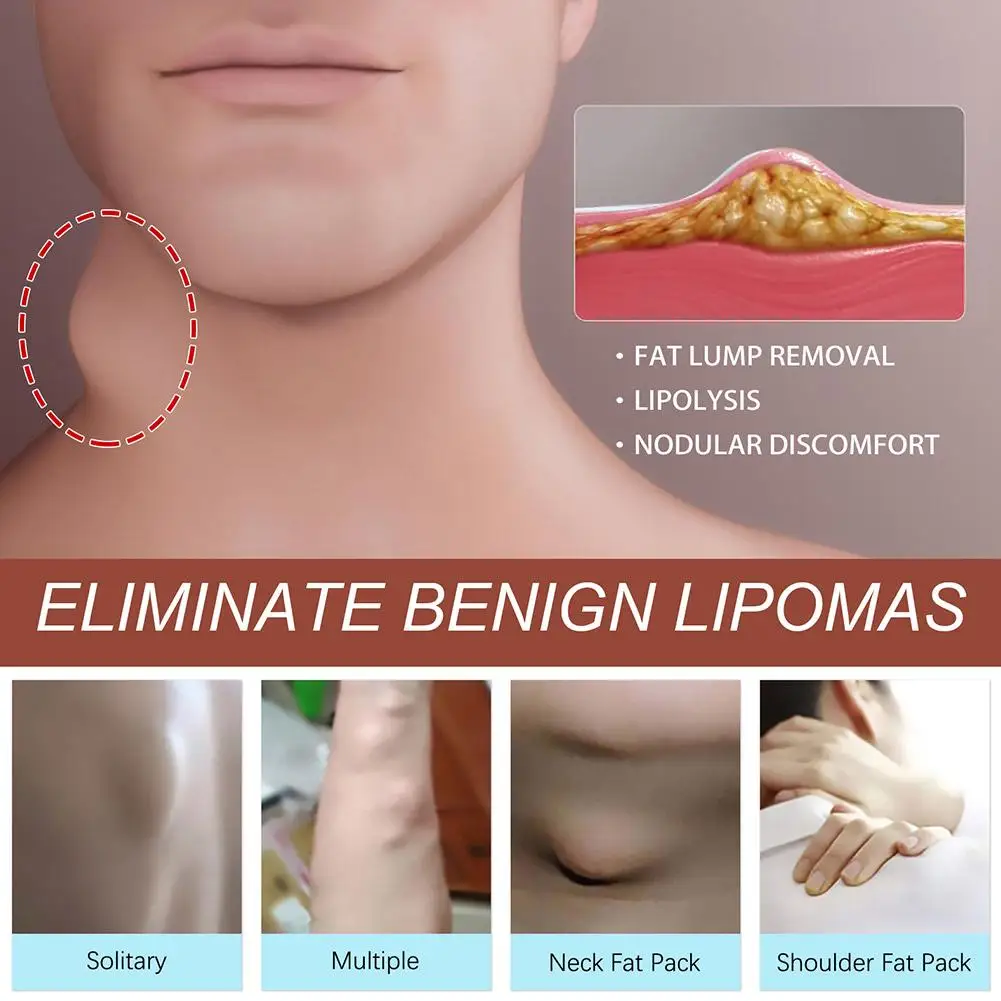 Krim penghilang Lipoma Herbal, krim penghilang lemak tubuh mudah digunakan untuk menghilangkan Lipoma Herbal 3 buah