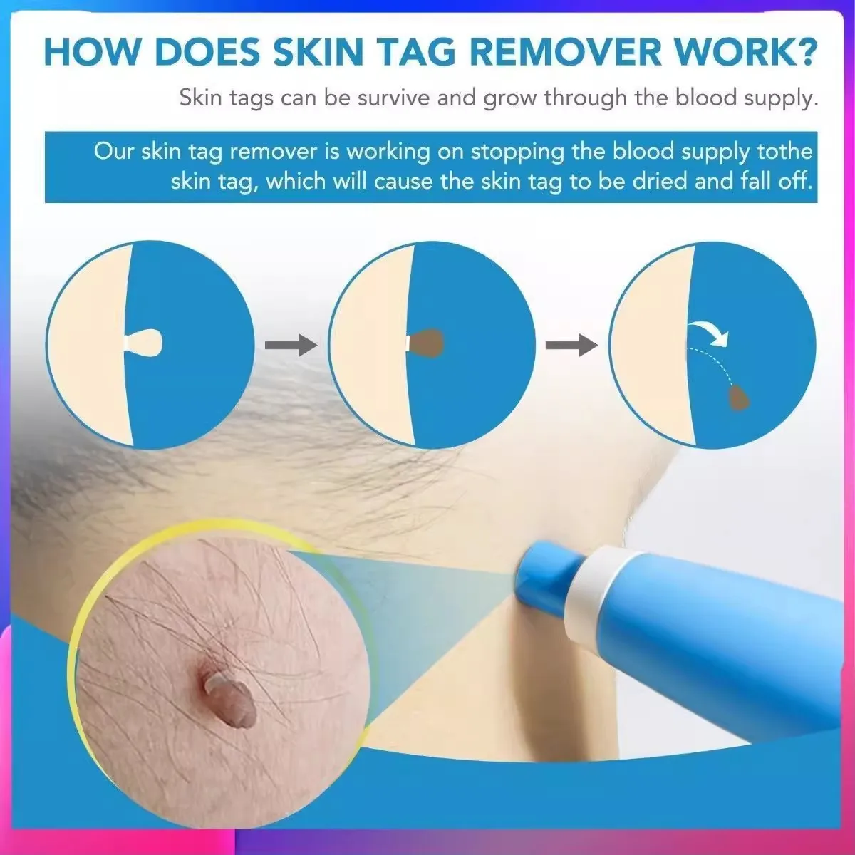 Skin Tag Removal Mole Wart Removal Facial Mole Wart Microstrip Tag Removal Kit Automatic Mole Remover Tool with Cleansing Swabs image 3