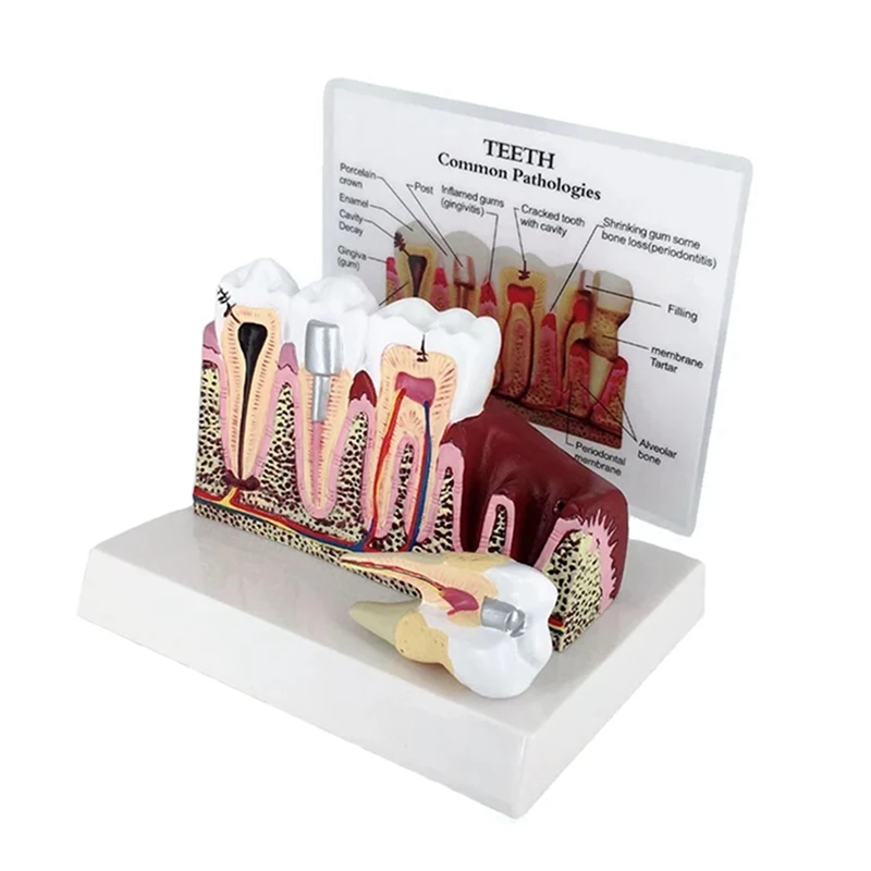 ABNO-Standard  Oral Teeth Anatomical Teaching Model Comprehensive Tooth Structure Model Dentist  Demonstration