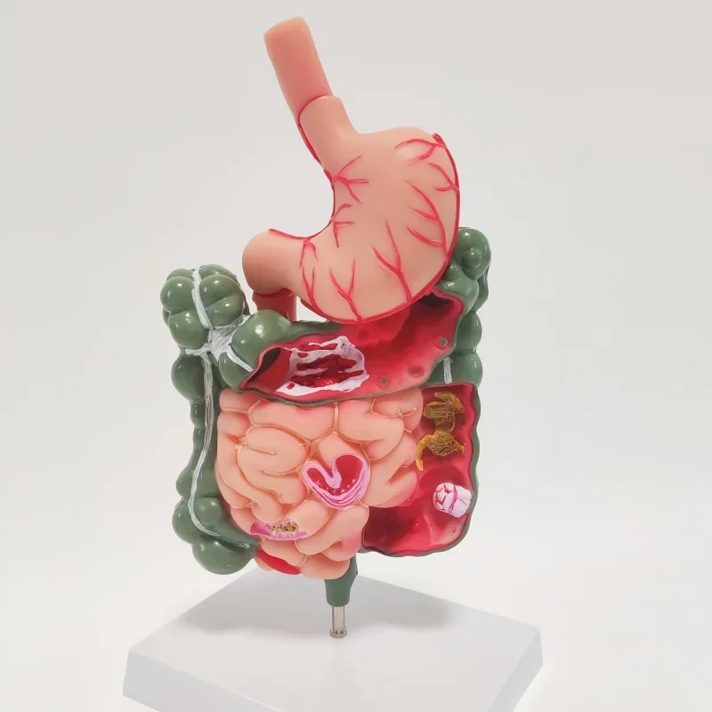 Removerable Human Stomach Anatomy Model Pathological Digestive System Teaching Model with Stomach Section Large Small Intestine