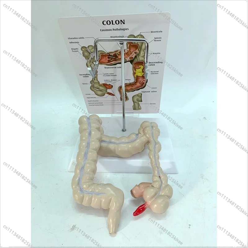 For Colon Pathology Model, Colon Model, Colon Lesion Model, Intestinal Disease, Human