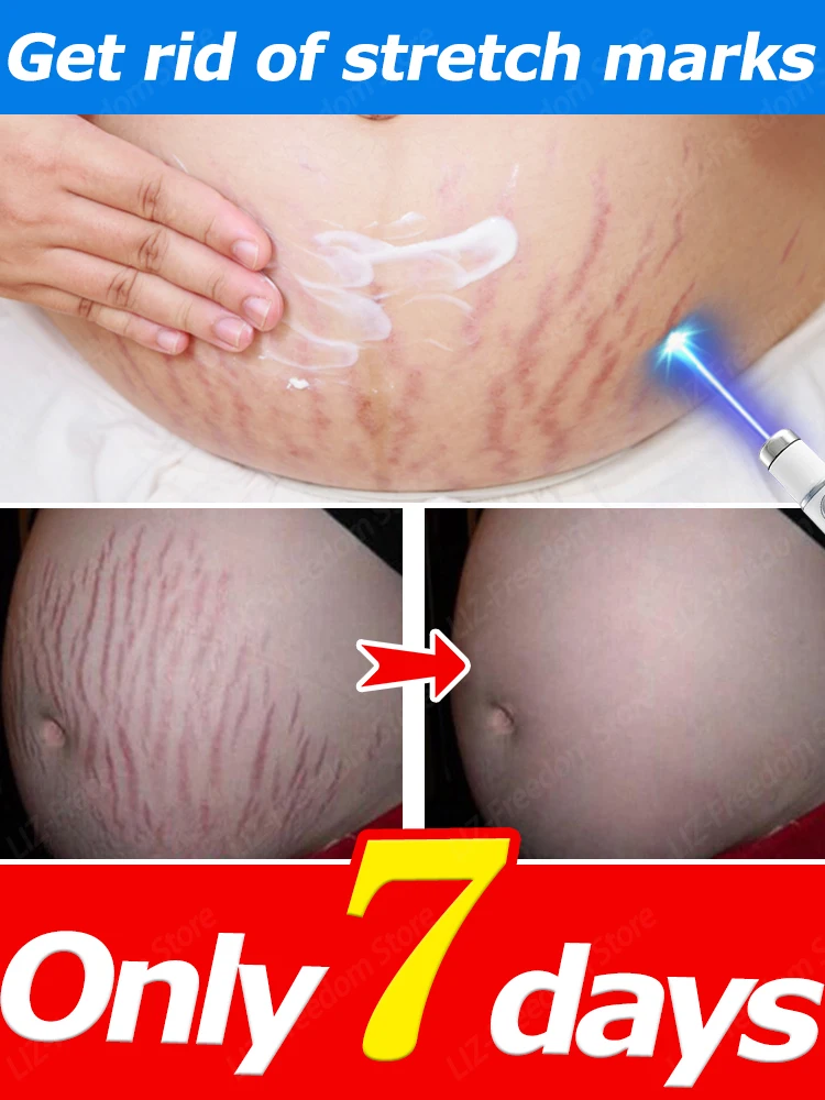 

Stretch Mark Cream Reduces Scar Lncrease Skin Elasticity Smoothes Firms