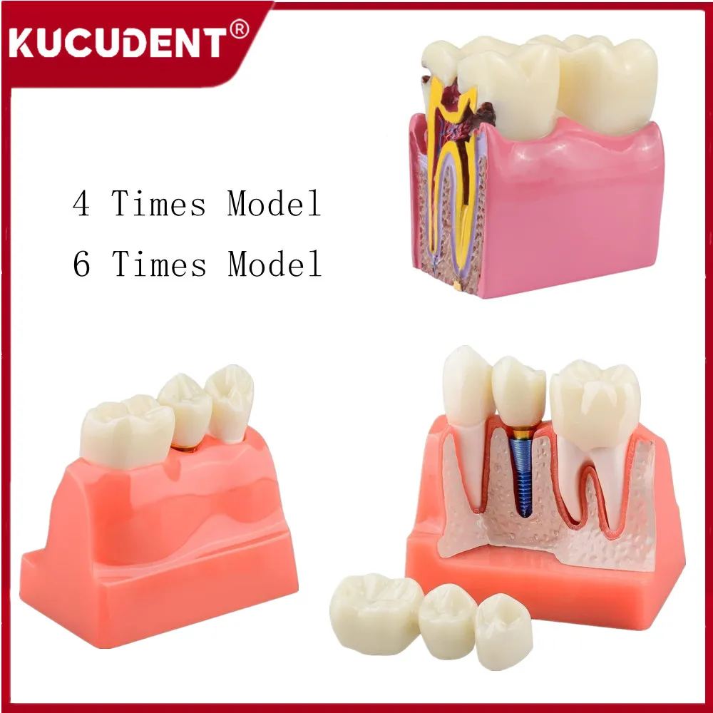 Dental Teeth Implant Model 4/6 Times Caries Comparsion Study Denture Models Analysis Crown Bridge Porcelain Restoration Study