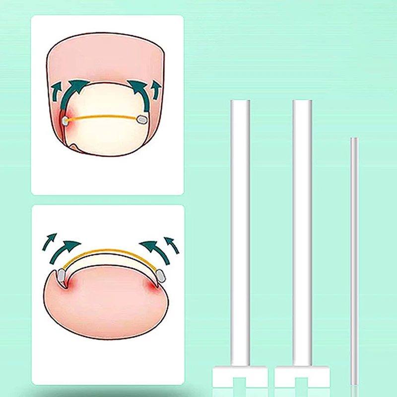 ペディキュア、埋め込み式つま先ネイルトリートメント用のingrown toenailは、プロのingrown toenail補正、フットケアツール