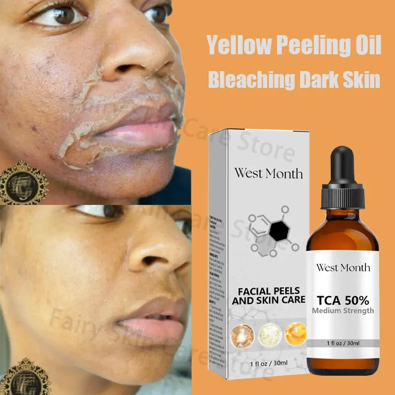 Yellow Peeling Oil Bleaching Dark Skin Spots Remove Dead Skin Lighten Melanin Exfoliating Whitening Moisturize Face Skin Care