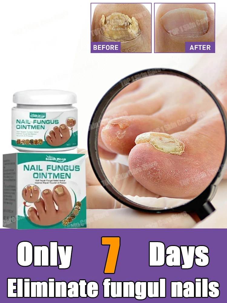 Toenail Drops Soften  Reliever Nail Fungal Treatment Feet Care Essence Anti Infection Nail Foot Toe  Fungus