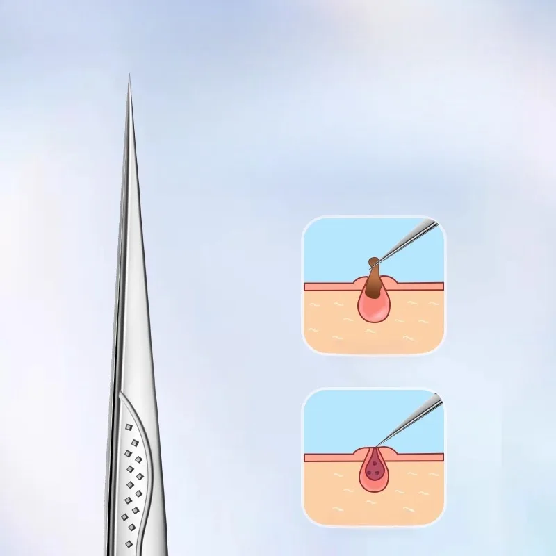 CMGF-セルピンセット、ビューティーサロンにきび除去ツール、ニキビ抽出および閉じた面皰除去ツールセット