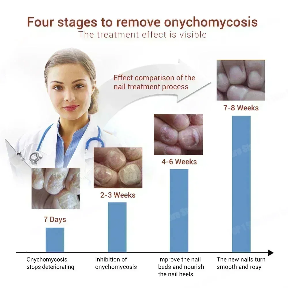 

Nail Fungus Treatment Liquid Feet Care Essence Nail Foot Repair Toe Nail Fungal Removal Gel Anti Infection Paronychia Onychomyco