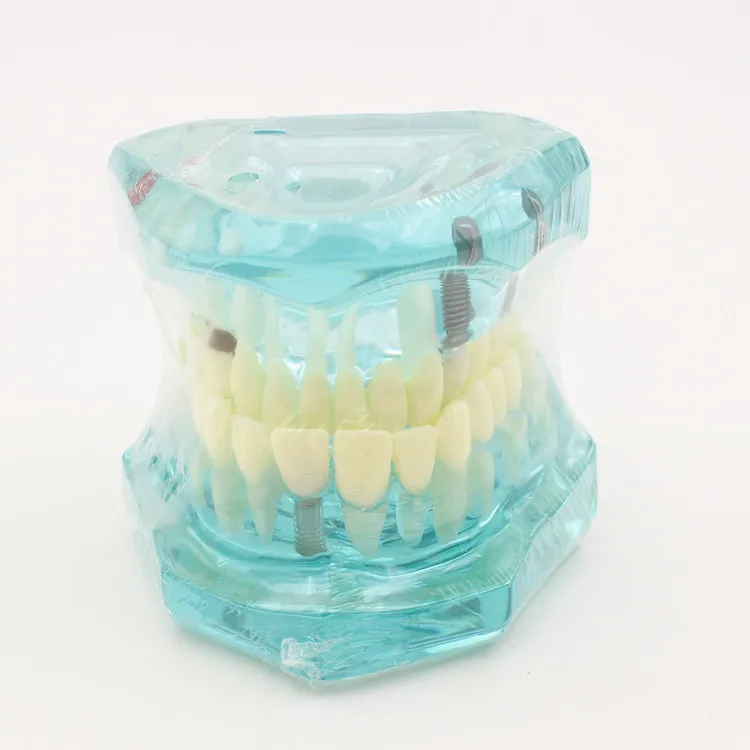 Dentalmodelle reparierbare Harzmodelle für erkrankten Zähne für den Unterricht und Forschung in Medizin und Zahnkrankungen – Detail 9