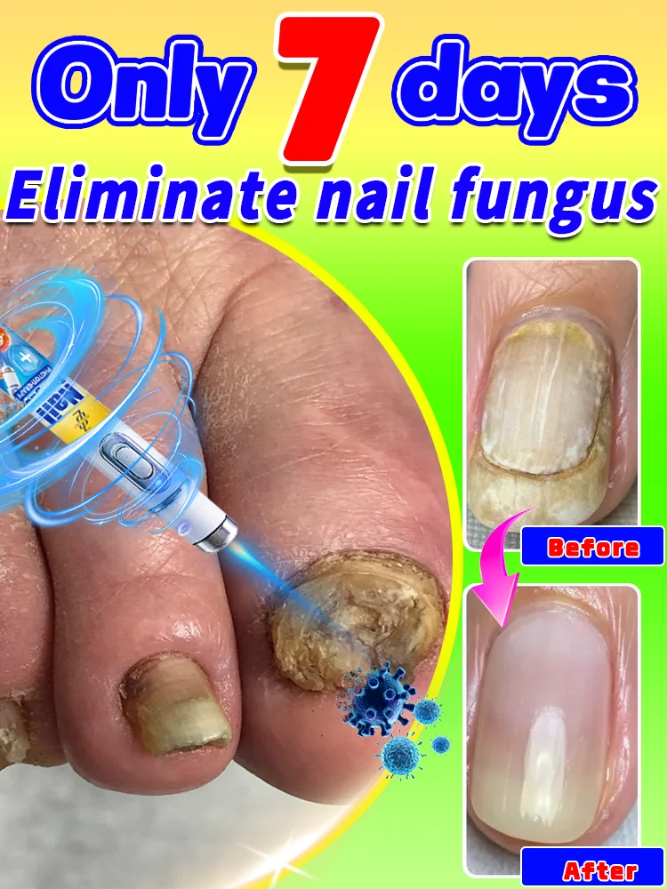 

Eliminate high-tech nail fungus, restore healthy nails, regenerate nails - anti-mold technology - adjustable temperature control