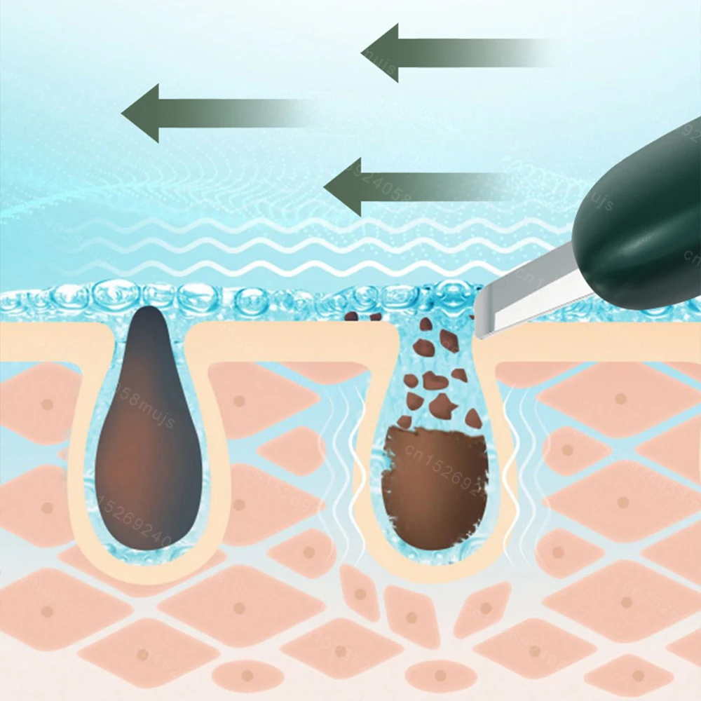 Haut wäscher Peeling Mitesser Entferner tiefe Gesichts reinigung Gesichts massage gerät Akne Poren reiniger Gesichts schaufel Reiniger Gesichts pflege Werkzeug