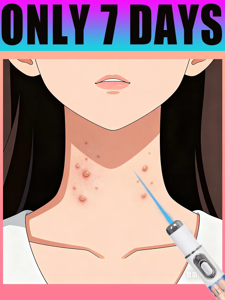 

Blue Light Pen - gentle, Say Goodbye to Warts Gently use at Home