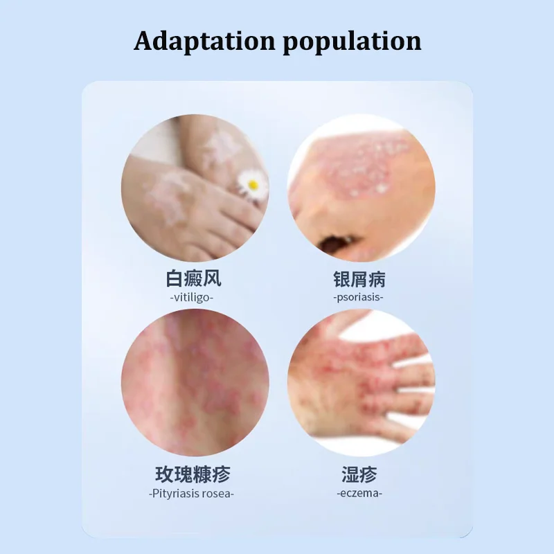 UVB العلاج بالضوء ضيق 311nm الأشعة فوق البنفسجية العلاج بالضوء مصباح الأشعة فوق البنفسجية العلاج بالضوء الصدفية للبهاق
