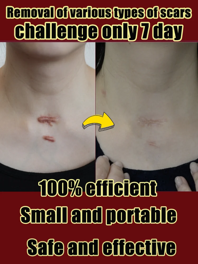 Der Arzt empfiehlt schnelle Ergebnisse |   Tragbarer Laserstift zur tiefen Reparatur und Narbenentfernung zu Hause