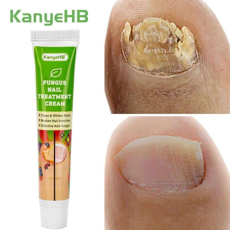 1Pcs Nail Fungal Treatment Ointment Anti Infection Paronychia Onychomycosis Foot Toe Nail Fungus Removal Cream Feet Care G004