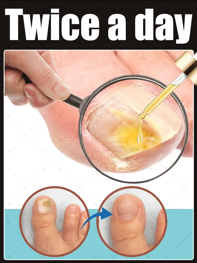 

fungal nail fungus treatment