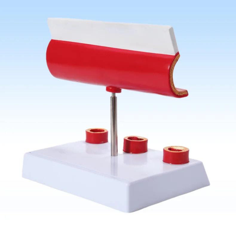 

Blocked blood vessels, pathological anatomical model of human blood vessels