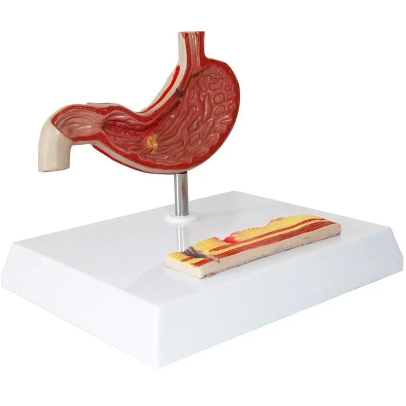 Human Anatomy Anatomy Stomach Medical Model Stomach Pathology Gastritis Ulcer Anatomy Medical Teaching Tool