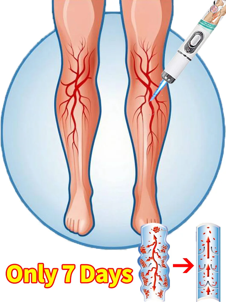 

Say byebye to vasculitis, phlebitis, spider leg pain, varicose veins