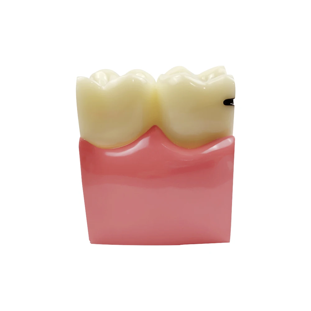 Model zębów Model porównania próchnicy stomatologicznej dla praktyki technika dentystycznego studiowania narzędzi stomatologicznych