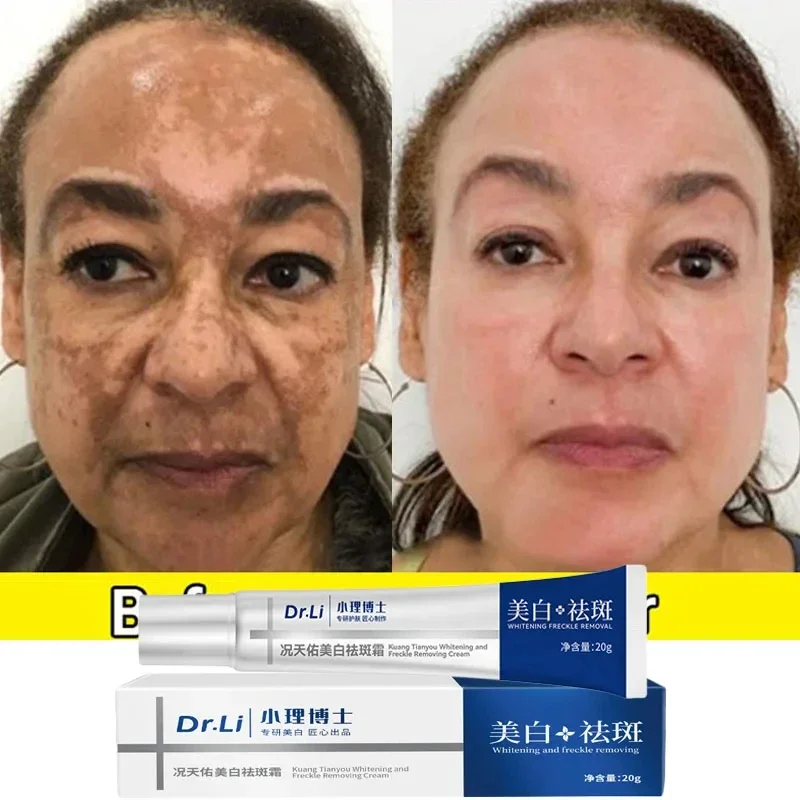 Effective Whitening Freckles Cream Remove Melasma Dark Spots Fade Pigmentation Moisturize Brighten Face Skin Care Product