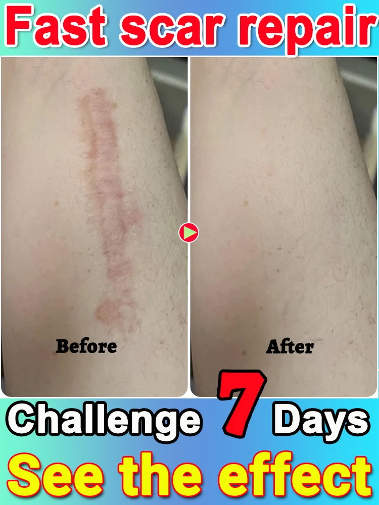 إذا كان لديك ندبات موجودة إلى سنوات، خذ هذا المنتج إلى المنزل
