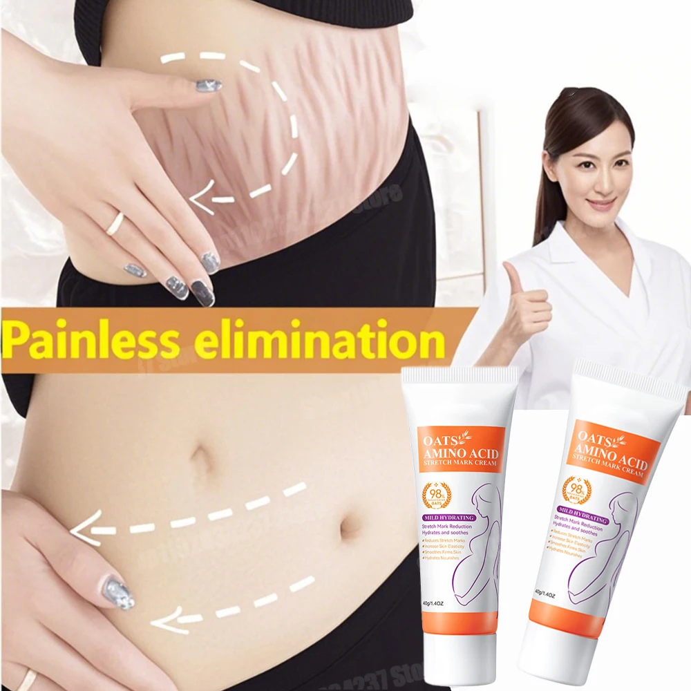 

Postpartum Stretch Marks Remover Cream Light Lines Obesity Pregnancy Care Powerful
