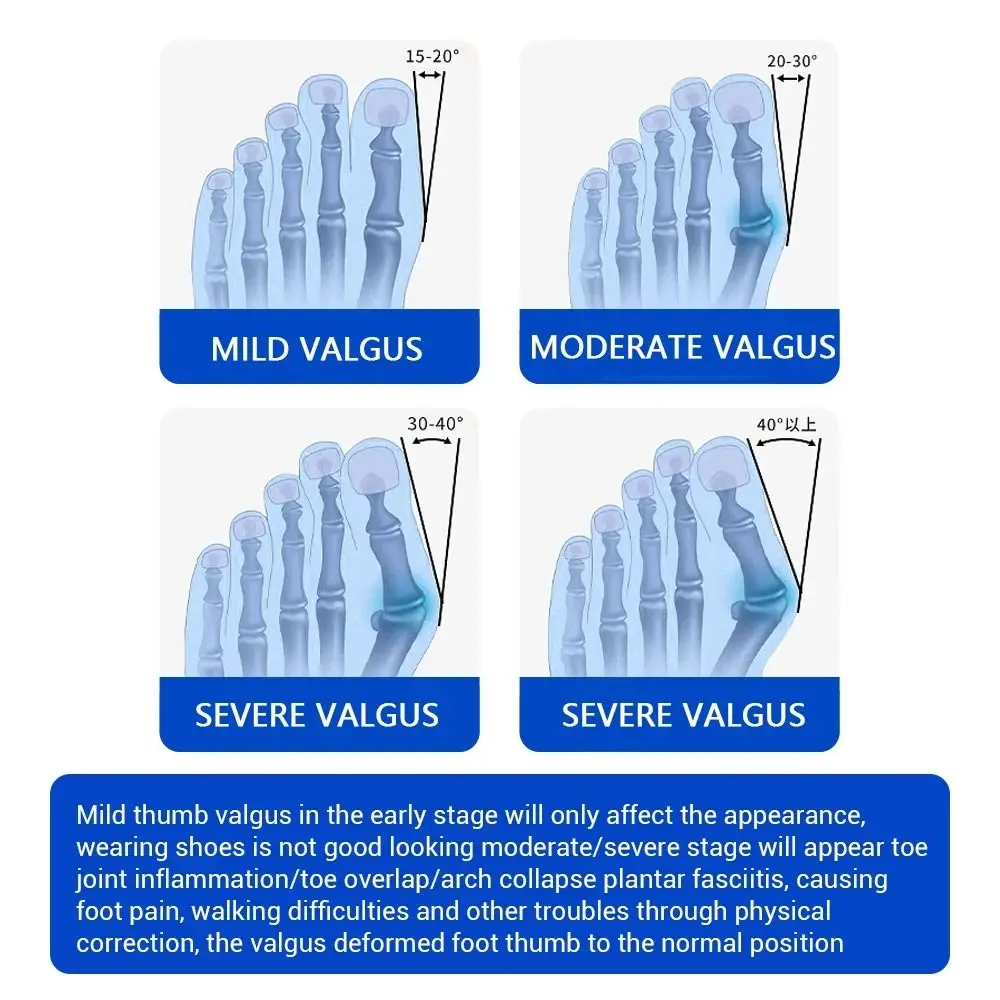 조절 가능한 무지외반증 교정기 미끄럼 방지 힐 스트랩 통기성 큰 발가락 교정기 착용하기 쉽고 편안함