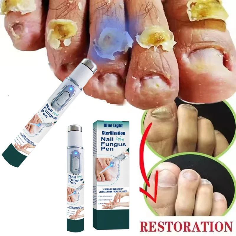 

Fungus Care Repair Pen Anti Fungus Blue Light Repair Pen Onychomycosis Painless Removal Foot Repair Products Laser Pointer