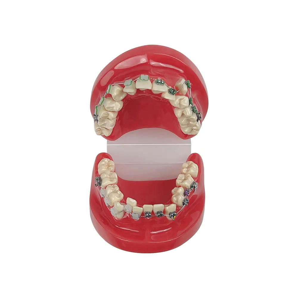 Orthodontic Teaching Model Dental Teeth Treatment Model With Metal & Ceramic Practice Studying Doctor-patient Communication