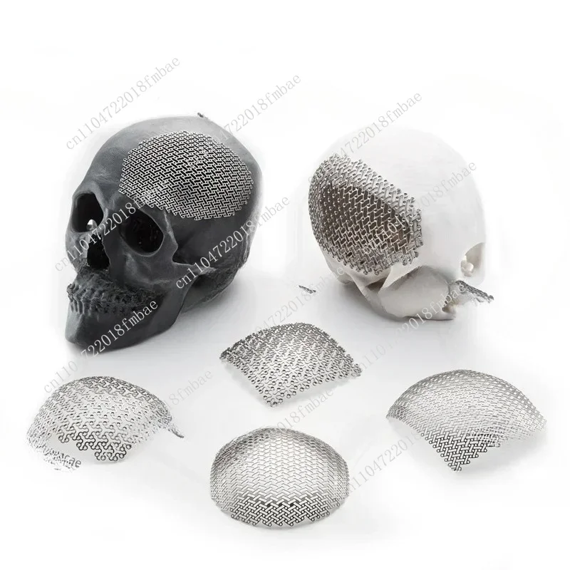 Osteopathic and Maxillofacial Neurosurgery System Cranioplasty with Titanium Mesh Screw Implants
