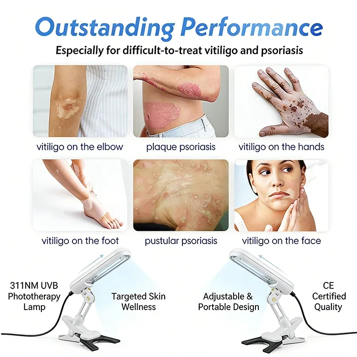 

UV Phototherapy Lamp 311nm Narrow Band UVB Light Treatment For Vitiligo Psoriasis White Spots