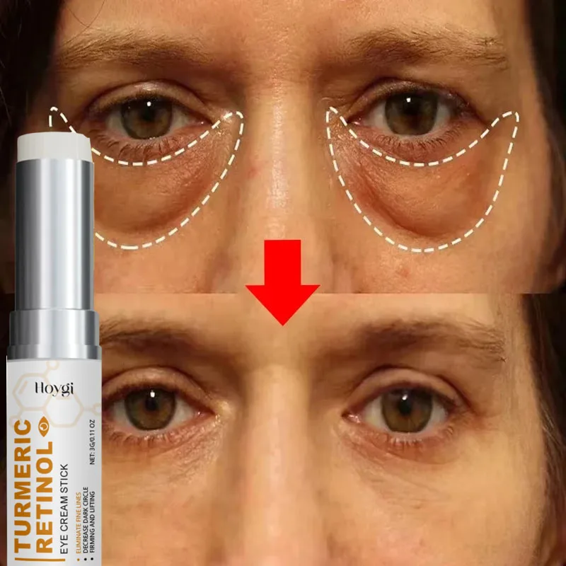 حقيبة العين الفورية إزالة كريم عين جزيئات الدهون الهالات السوداء الانتفاخ تتلاشى الخطوط الدقيقة رفع سطع الجمال الكوري العناية بالعين