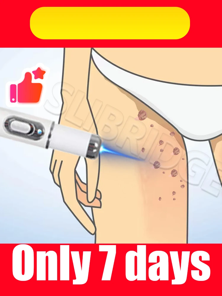 قلم الضوء الأزرق الثآليل يحل الثآليل المختلفة، 2025 أدوات العناية بالضوء الأزرق رائجة البيع