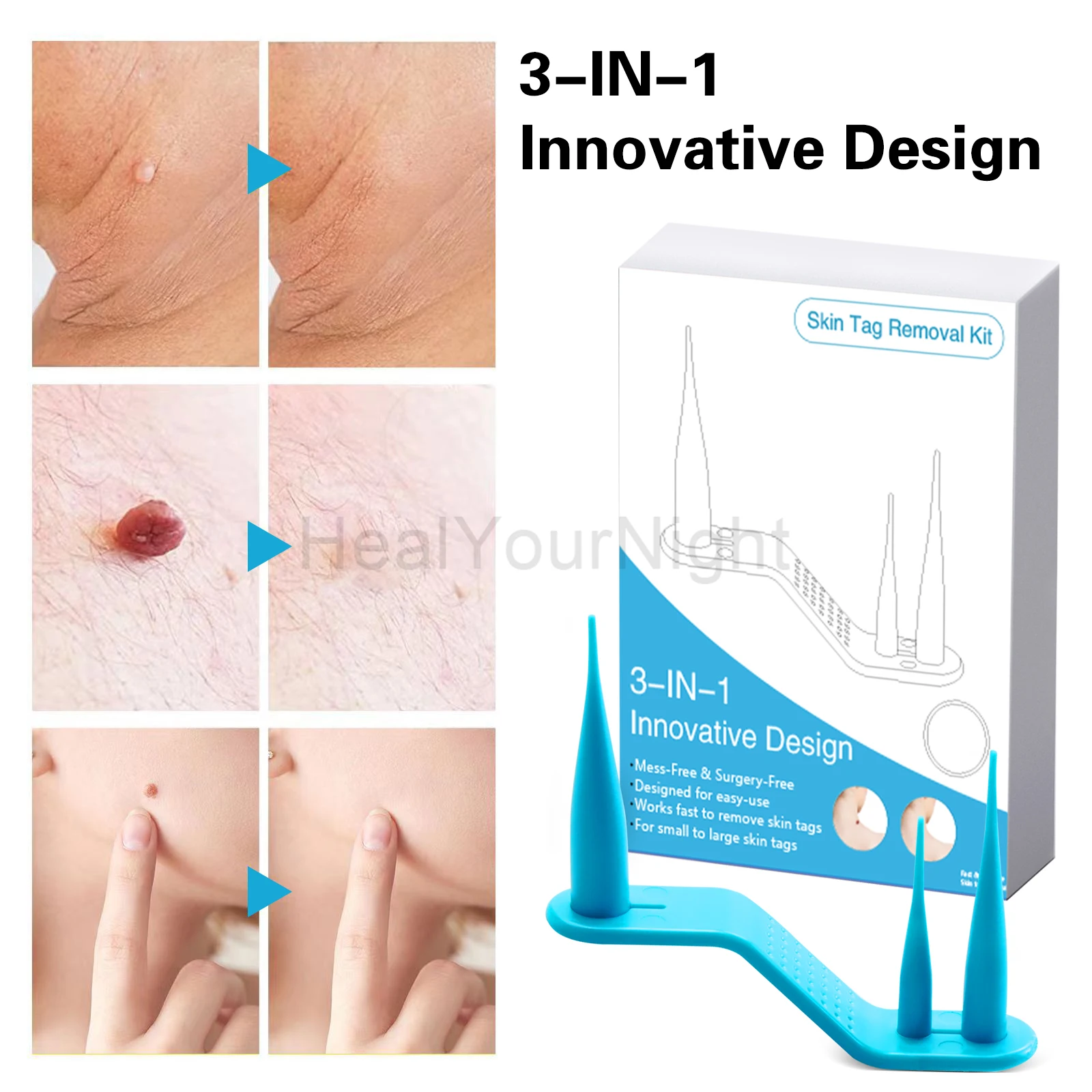 เครื่องมือดูแลความงามบนใบหน้า 3-IN-1 Auto Skin Tag Removal Kit ไม่เจ็บปวดผิวป้าย Mole สิวกําจัดหูดชุดปากกาทําความสะอาด Swabs