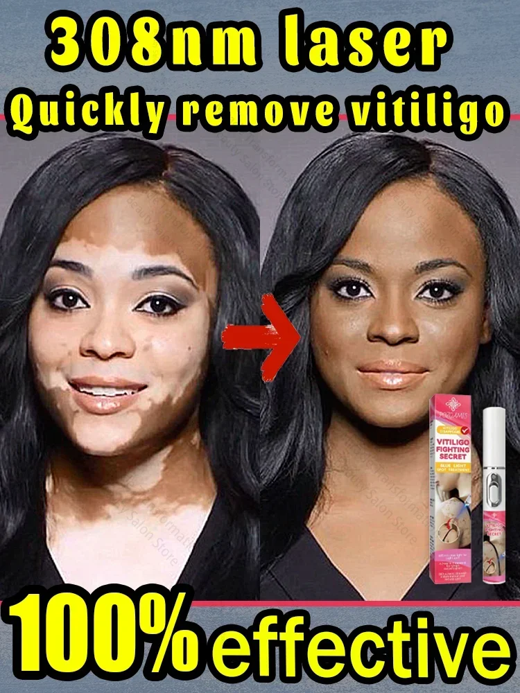 Tratamiento efectivo para el vitiligo