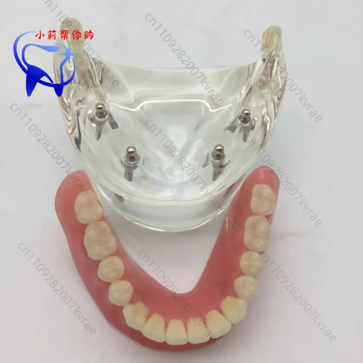 

2/4-Nail New Planting and Restoration Model Teeth Display Model, Teaching Dental Study Model