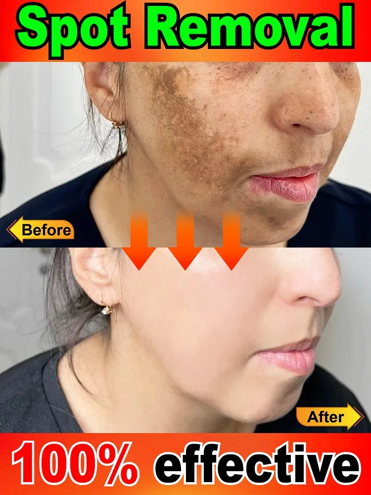

100% effective in solving all pigmentation symptoms