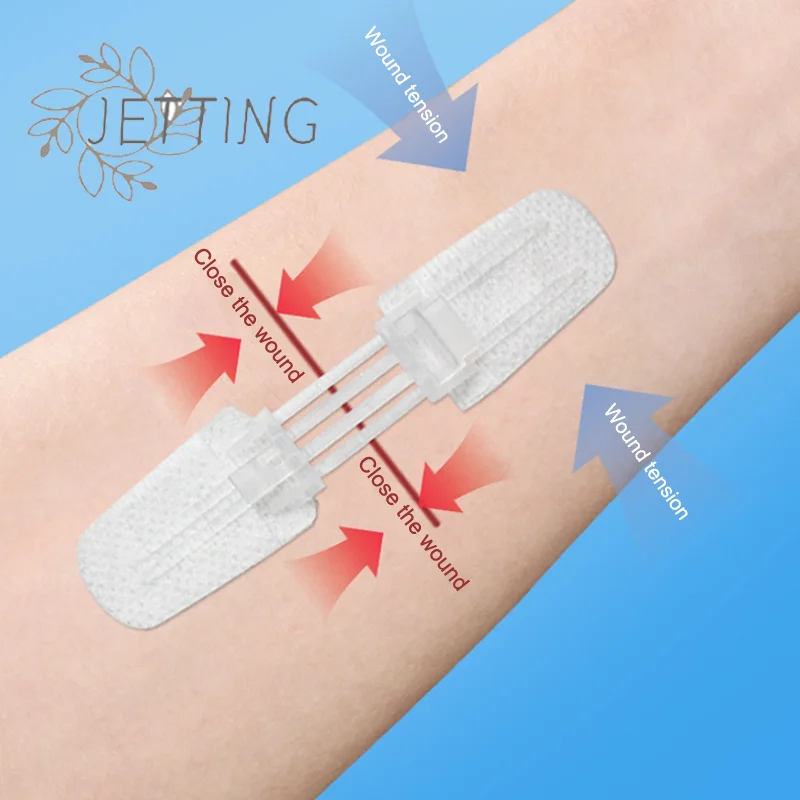 

Лидер продаж, 1 шт., пластырь на молнии, безболезненный пластырь для закрытия ран, пластыри для перевязки на рану без швов, пластырь для уменьшения швов на молнии, пластырь для улицы