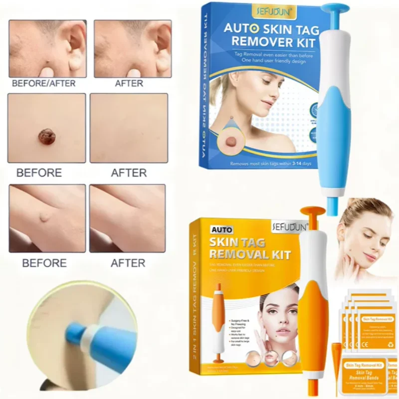 Acne Light Therapy Pen - Kit Removedor de Verrugas para Verrugas