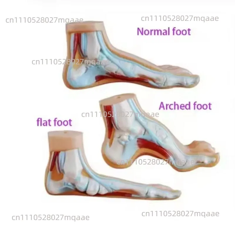 Foot Pathology Model Normal/Flat/High Arch Foot Anatomy with Muscles Bones Medical Teaching Display for Podiatry Education