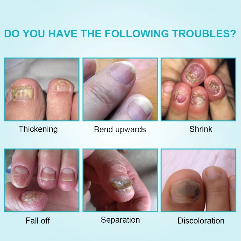 Cura delle unghie Soluzione per il trattamento dei funghi Mani Piedi Anti-Infezione Ispessimento delle unghie Curling Peeling Atrofia Onicomicosi 3ml